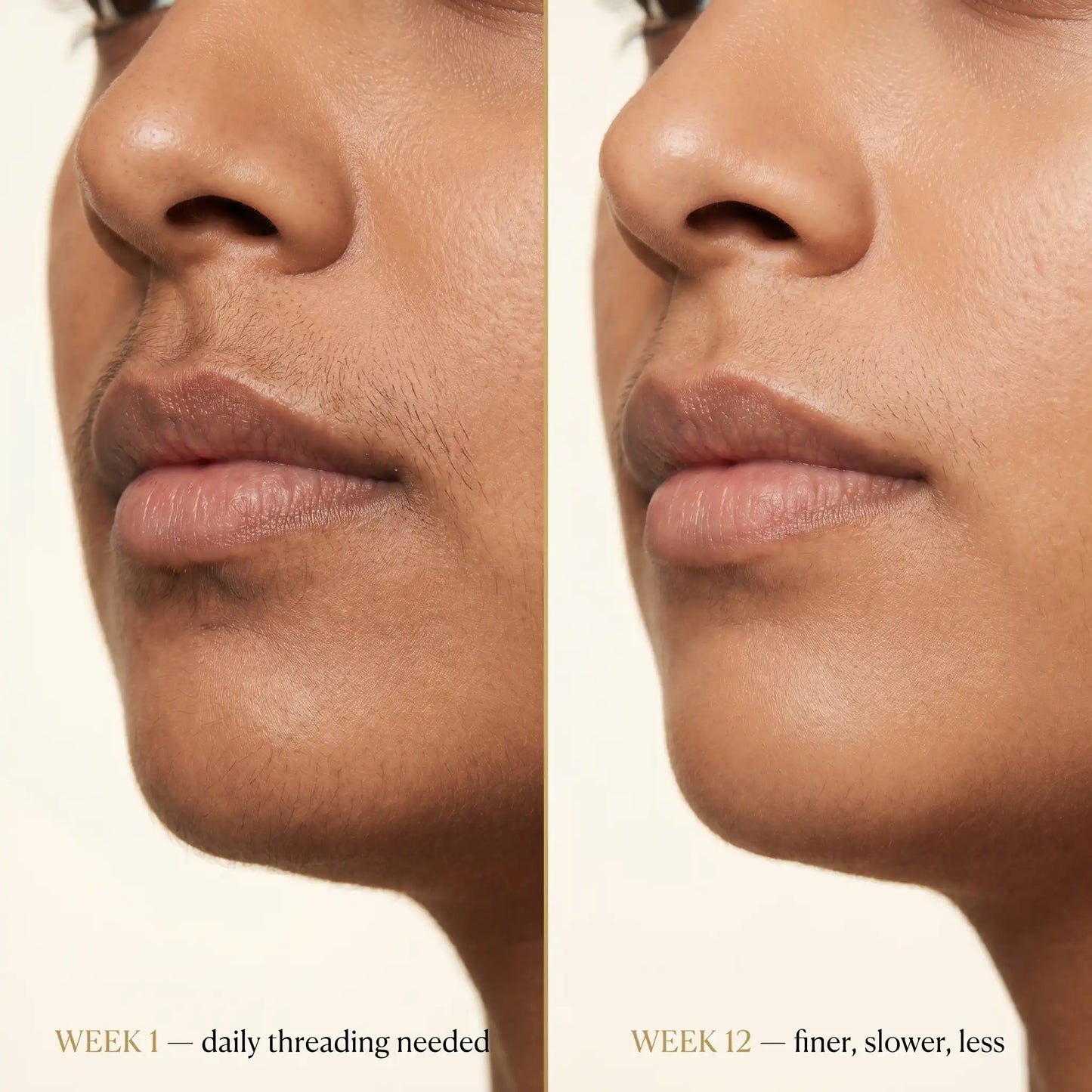 Before and after — upper lip Week 1 vs Week 12 with Cypervedha
